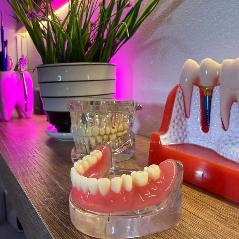 Modelo de coronas de zirconio y puente fijo sobre implante dental
