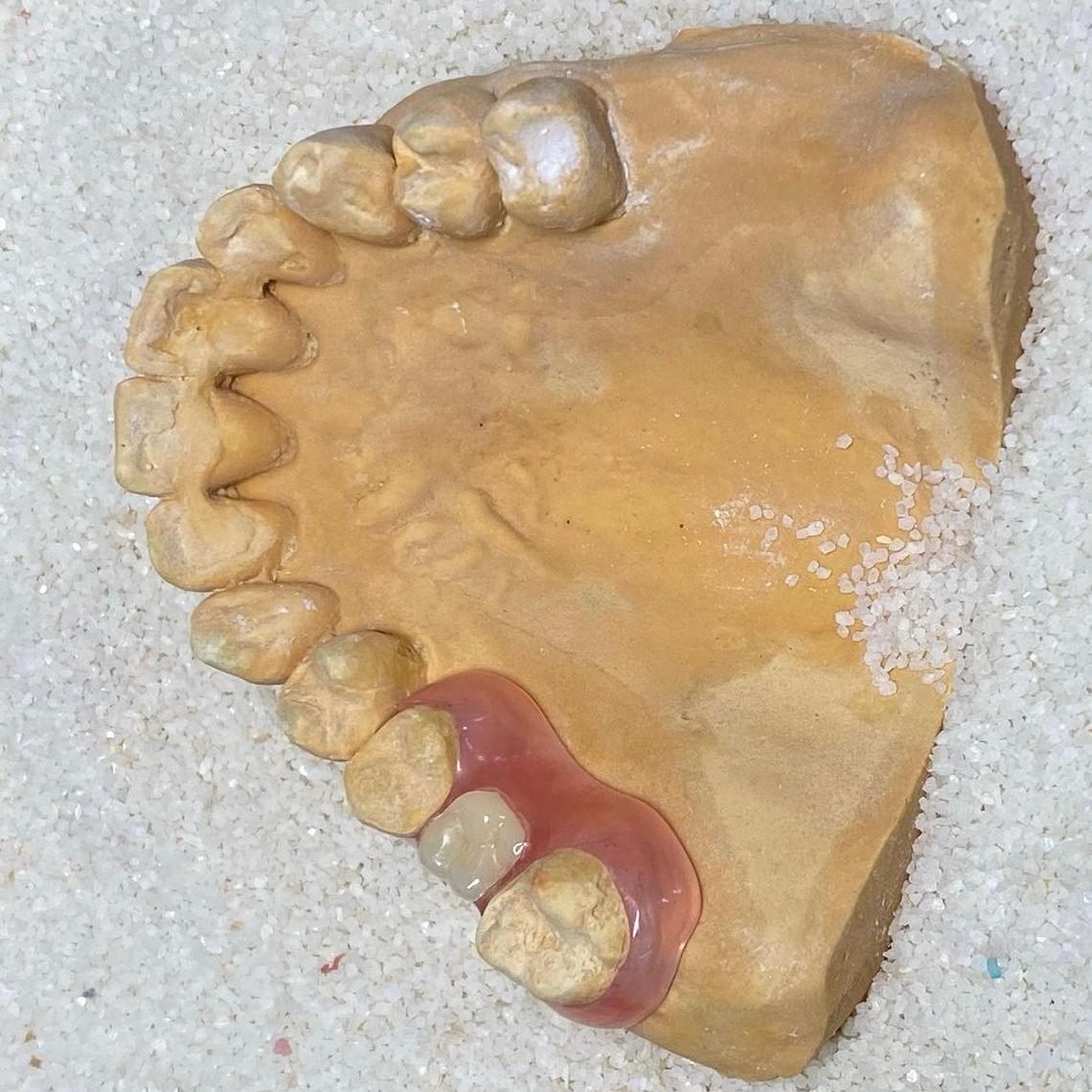 Prótesis parcial de supersucción fabricada por Sabogal Dental