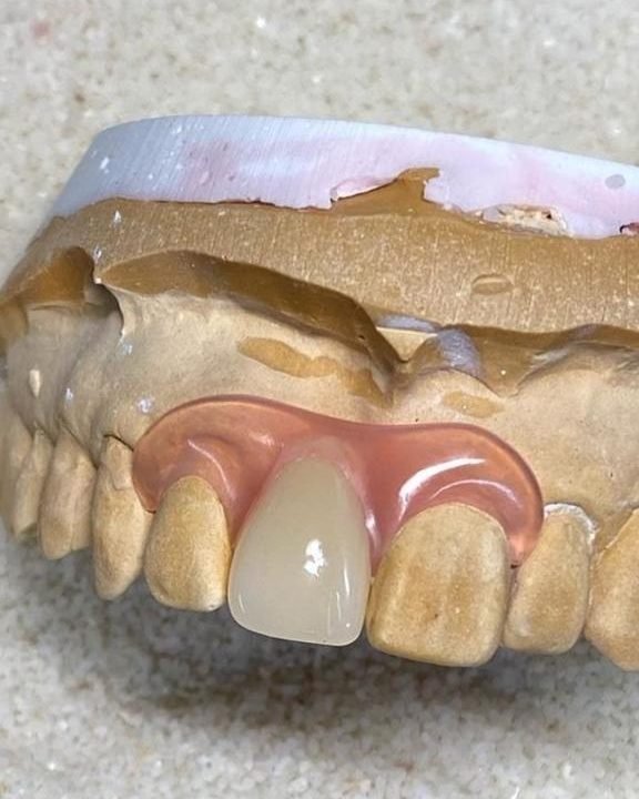Diente provisional fabricado en el laboratorio de Sabogal Dental